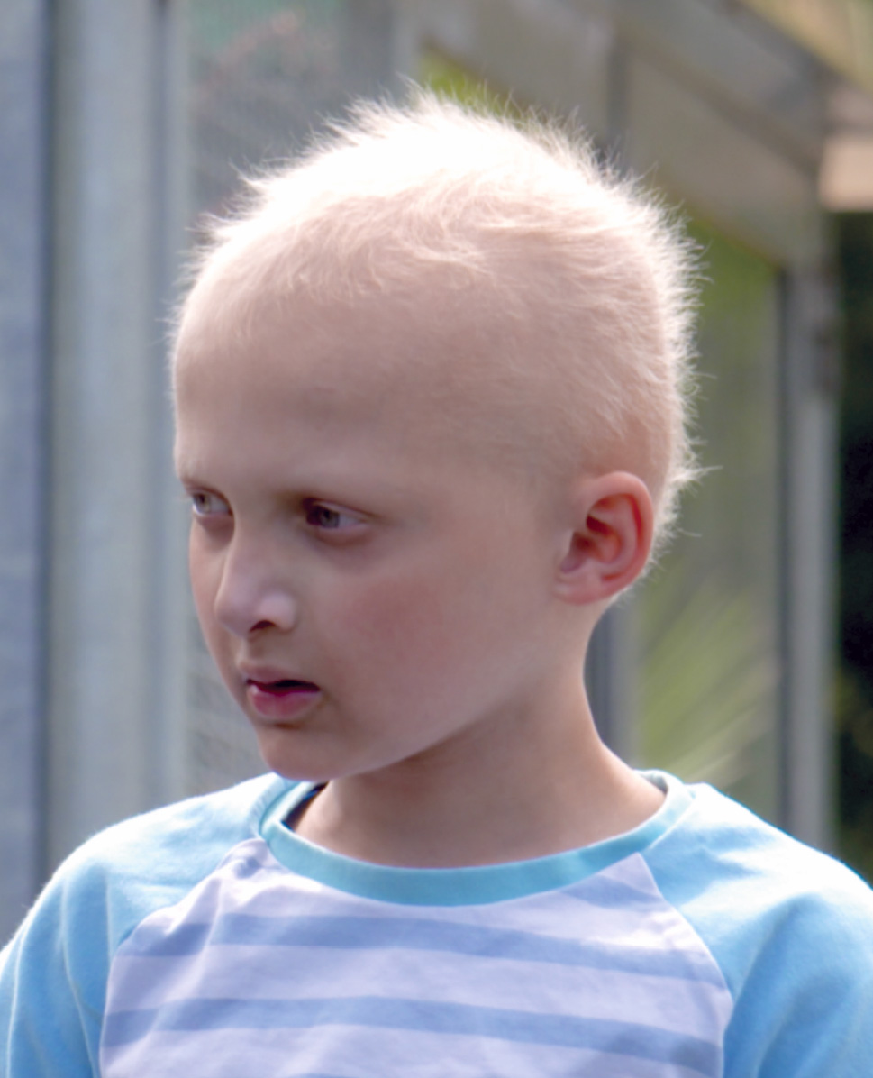 Foto eines Jungen mit X-chromosomaler hypohidrotischer Dysplasie